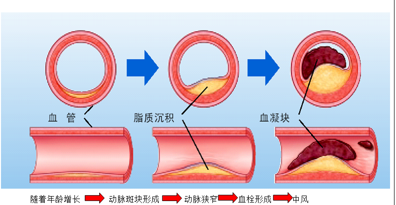 急性脑卒中